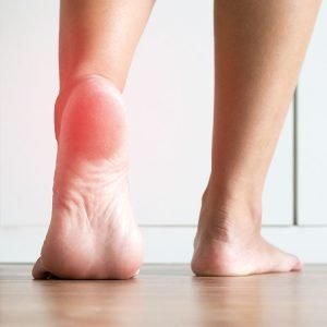 Plantar Fasciitis